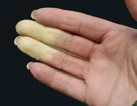 Infracare Pyro Gloves for Cold Hands